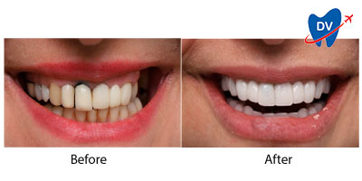 Cosmetic dental work in Algodones Before & After