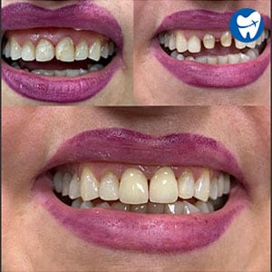 Dental Crowns Before & After in Albania