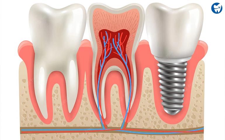 Dental Implants Vs Root Canal (RCT)