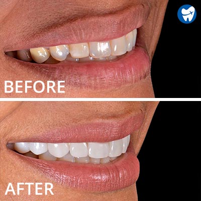 Dental veneers - before and after