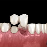 Dental Bridges