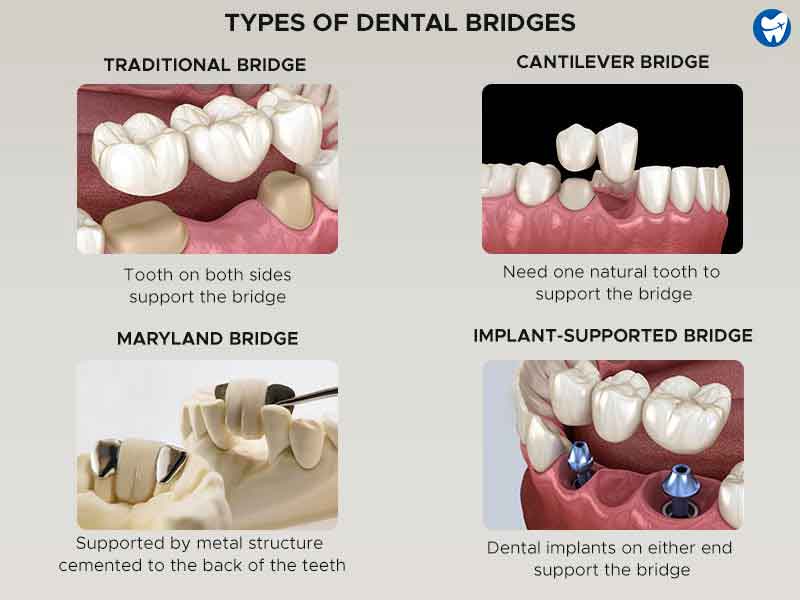 Types of Dental Bridges