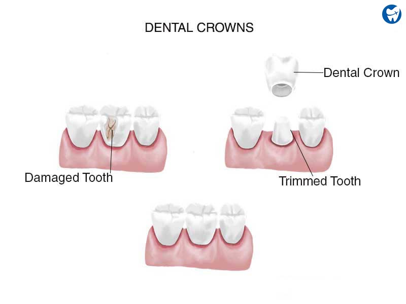 Tooth Trimming for a Crown