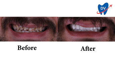 Dental Crowns in Turkey | Before & After