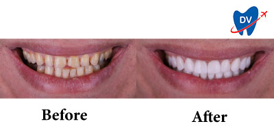Before & After: Dental Crowns in Turkey
