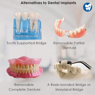 Alternatives to dental implants