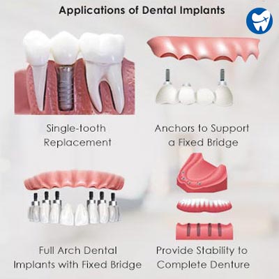 Applications of Dental Implants