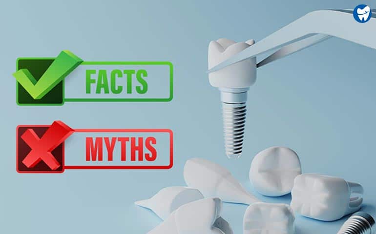 Dental Implants | Myths & Facts