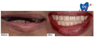 Dental Work in Ho Chi Minh City, Vietnam | Before & After