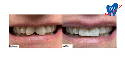 Dental Work in Ho Chi Minh City, Vietnam | Before & After