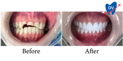 Dental crowns in Hanoi - Before & After