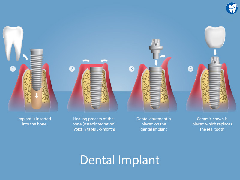 Dental Implants Process | Monterrey