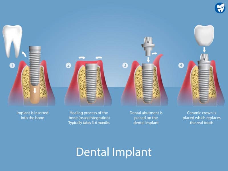 Dental Implants Technique
