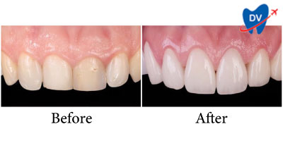 Dental veneers in Hanoi : Before & After