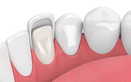 Dental-veneers