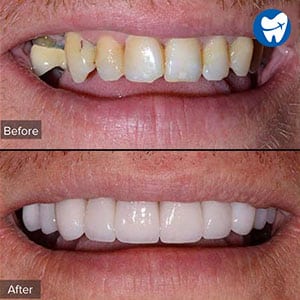 Dental implants in Dubai - Before & After