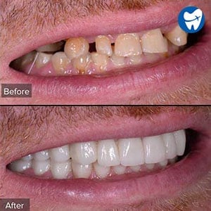 Dental implants in Dubai - Before & After