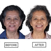 Full Mouth Reconstruction with All on 4 Dental Implants