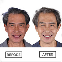 Full Mouth Reconstruction with All on 4 Dental Implants