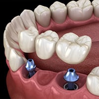  Puente soportado por implantes