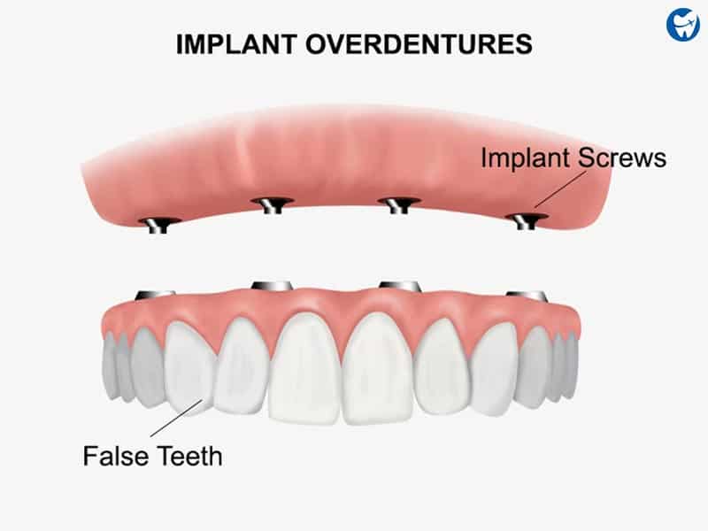 Is my mouth worth saving or should I get dentures? : r/askdentists