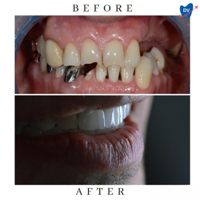 Dental Implants in Romania (Before & After)