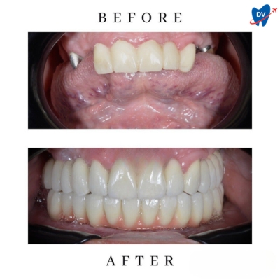 Dental Implants in Romania (Before & After)