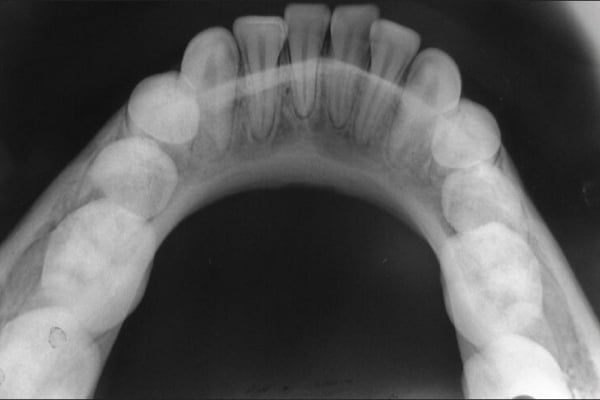 Occlusal x-ray