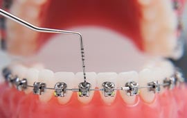 Orthodontic-treatment