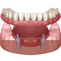 Multiple Implant Denture in Nogales