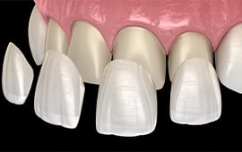 Porcelain Veneers