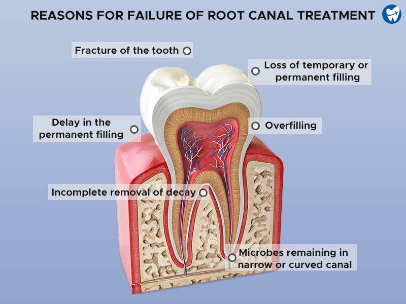 Reasons for failure of root canal therapy