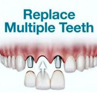 Multiple teeth replacement