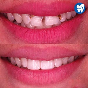 Restoration With Composite Veneers in Indonesia: Before and After
