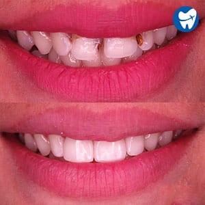 Composite Veneers 