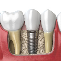 Single Dental Implant in Nogales