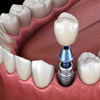 Implante dental individual