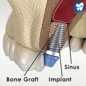 Sinus Lift