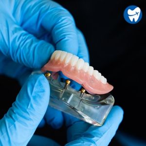 Snap On Dentures
