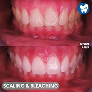 Teeth Whitening in Indonesia: Before and After