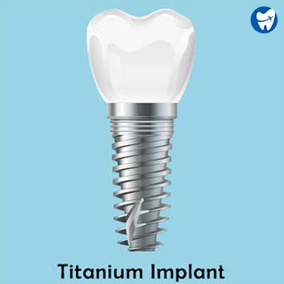 Titanium Implant