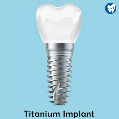 Titanium implant