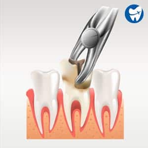 Tooth extraction in Albania