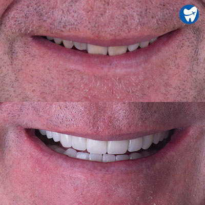 Zirconia Crowns – Before & After