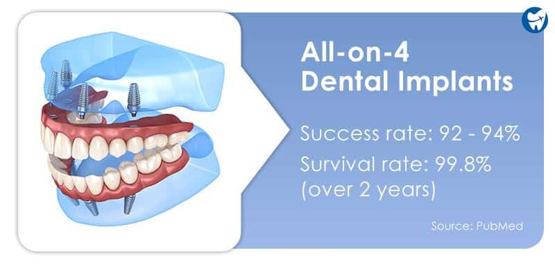 Success rate of All on 4 dental implants