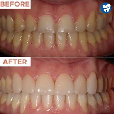 Dental Veneers: Before and After Treatment