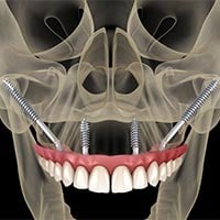 Zygomatic implants