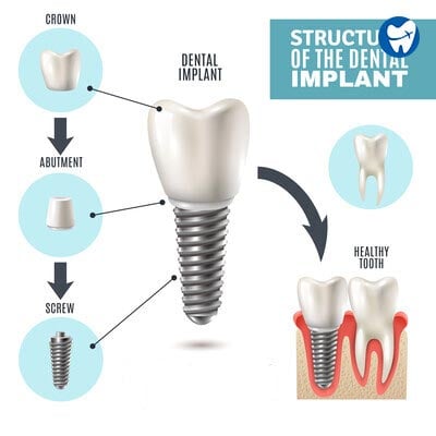 Parts of a dental implant