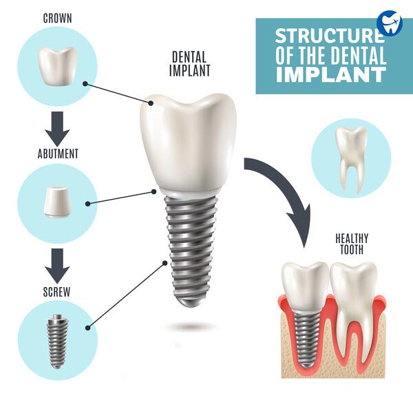 Structure of Dental Implants