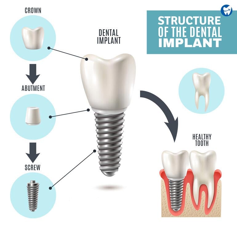 Structure of dental implant